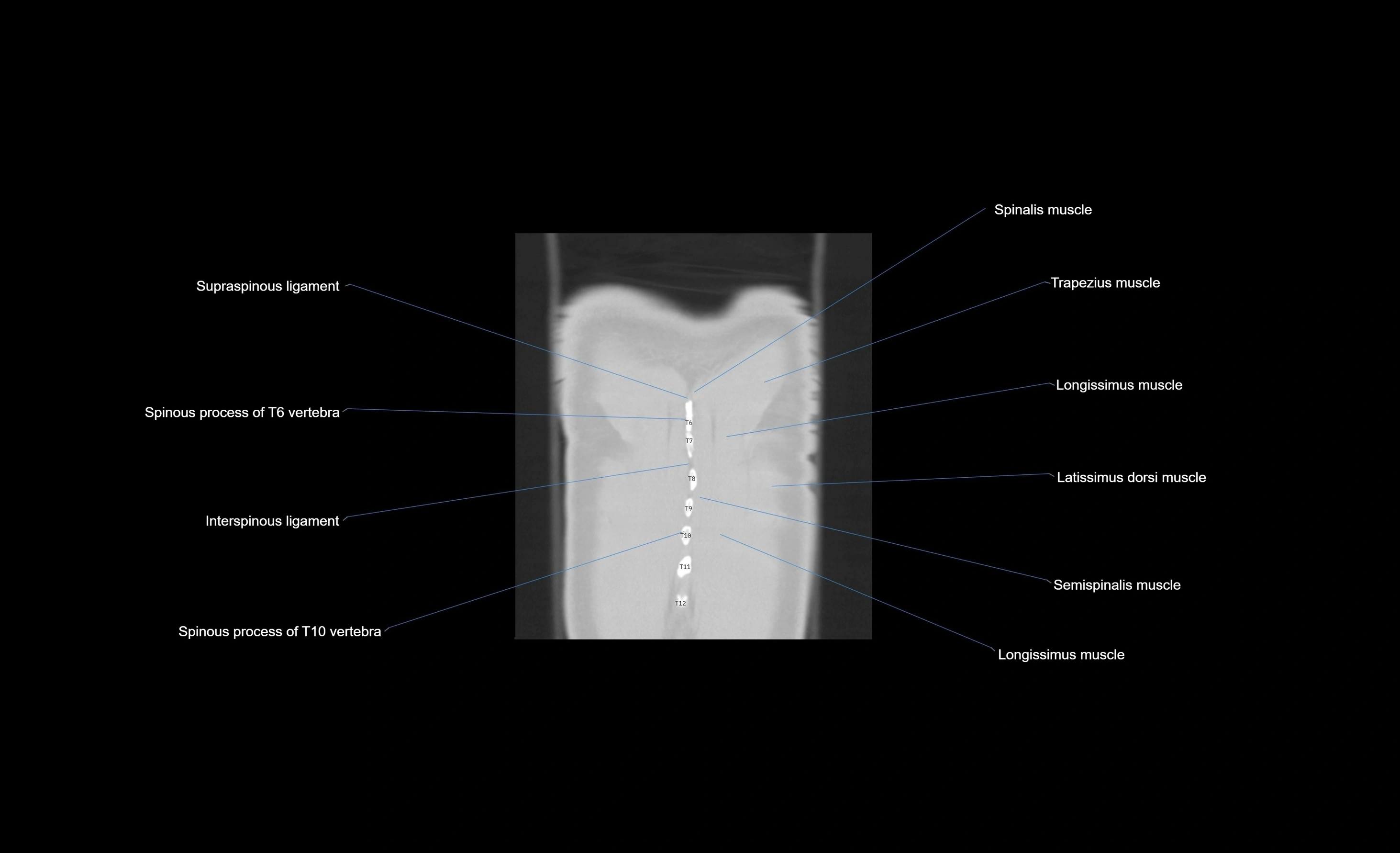 CT chest (thorax) labelled coronal cross sectional anatomy radiology image-00008.webp